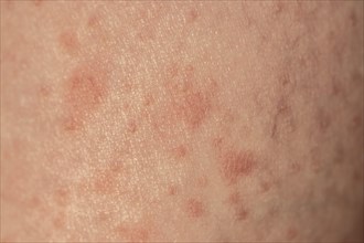 Skin with reddened spots