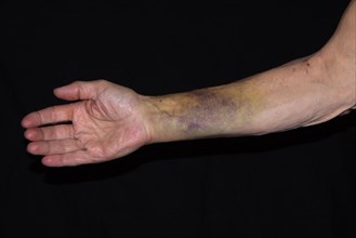 Patient with a bruise