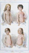 The four children's diseases