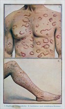 Annular psoriasis and itching patches