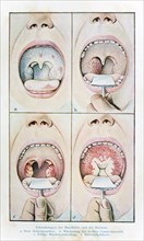 Diseases of the oral cavity