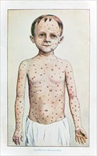 Skin rashes in syphilis