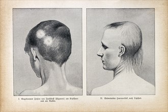 Absence of dye on the hair of the head and significant hair loss after typhoid fever