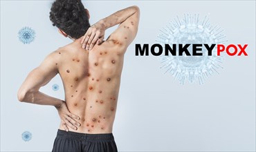 People with monkeypox on isolated background