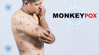 A person with monkeypox on his body