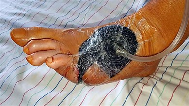 Vacuum therapy after surgery for diabetic foot syndrome