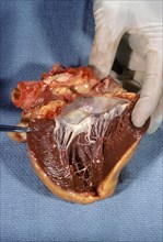 Human heart showing the endocardium & myocardium w/ mitral valve