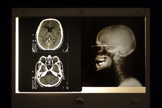 X-ray image of skull and cranial computed tomography scan viewed on light box