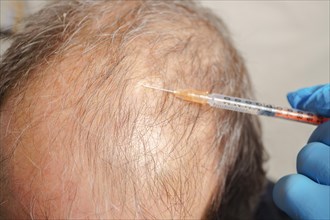 Hair transplantation, hair follicle transplantation, treatment of baldness and strengthening the scalp
