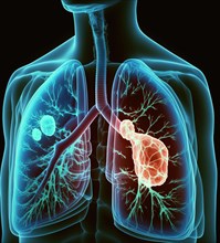 Schematic representation of a lung with bronchi and bronchioles as well as expression of a metastatic lung carcinoma