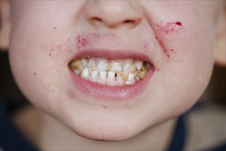 Symbolic photo. A boy shows his teeth after eating