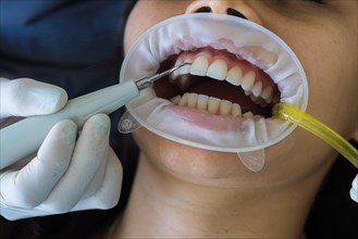 Close-up of hygienic cleaning of teeth from plaque. Dentist's hands clean patient's teeth from plaque with special device. Concept of whitening