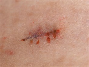 Surgical wound stitches removed