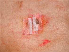 Surgical wound with steri strips and iodine tincture