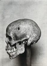 A human skull with a hole where a cranial operation was performed