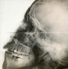 X-ray of a human skull