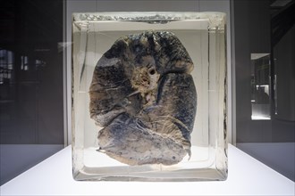 Dust lung of a miner