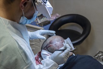 Hair transplant. Surgeons in the operating room carry out hair transplant surgery