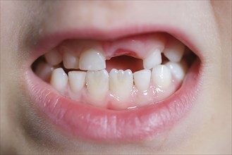 Symbolic photo on the subject of milk teeth. A six-year-old boy shows his teeth with a gap. Berlin,