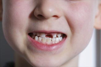 Symbolic photo on the subject of milk teeth. A six-year-old boy shows his teeth with a gap. Berlin,