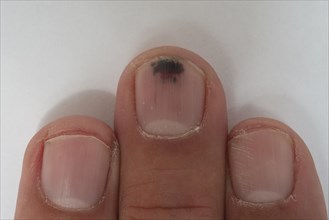 Nail haematoma, bruise, on middle finger, Baden-Wuerttemberg, Germany, Europe