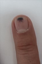 Wga20140605002 Nail haematoma, bruise, on the middle finger, Baden-Wuerttemberg, Germany, Europe