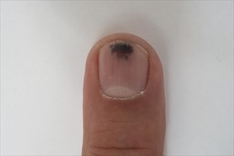 Wga20140605002 Nail haematoma, bruise, on the middle finger, Baden-Wuerttemberg, Germany, Europe