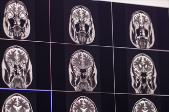 Several MRI images of a brain on screens showing medical analysis and diagnostics