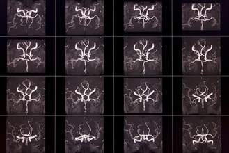 Black and white MRI images of a human brain showing the arteries in different layers, organised in