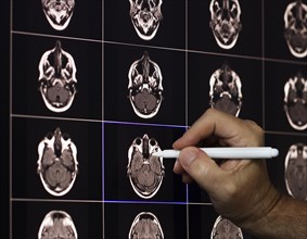 A hand points with a pen to MRI scans of brains displayed on a screen
