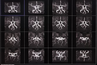 Several MRI images show the arteries of the brain in black and white with detailed neuronal