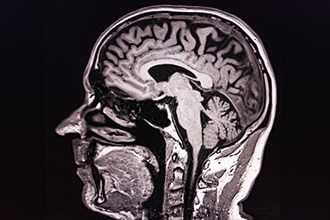 Lateral black and white MRI scan of a human brain and skull