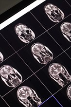 Multiple brain MRI scans on a monitor during a medical examination