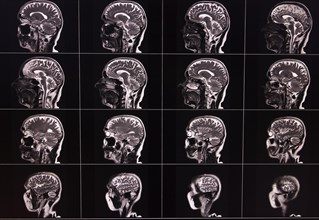 Several lateral MRI images of a brain showing different layers and details
