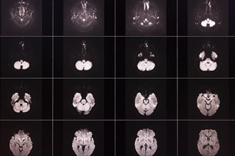 Several black and white MRI scans of a brain in different layers and angles, organised in a matrix