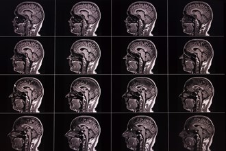 Several lateral MRI images of a brain, displayed in a matrix, show different layers