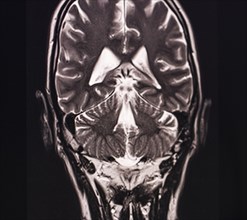 Black and white MRI image of the human brain showing detailed structural information