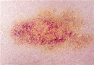 Closeup on a Bruise on wounded woman leg skin