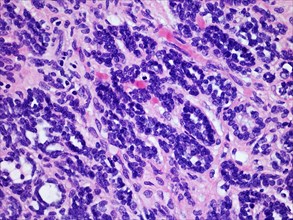 Microscopic image of a Wilms Tumor or Nephroblastoma of a childs kKidney viewed at 400x