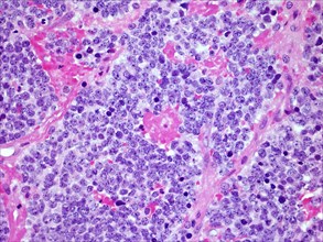 Microscopic image of a Neuroblastoma malignant tumor of the adrenal gland viewed at 300x