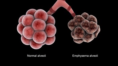 Medical comparison of healthy alveoli and an unhealthy emphysema alveoli