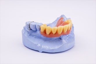 Removable denture of an upper jaw, denture, denture, dentist, dental impression