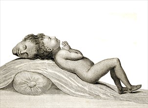 A child with two heads joined at the apex, Siamese twins, Double malformation, a maldevelopment in