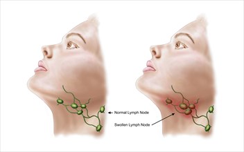 Anatomy of swollen lymph nodes