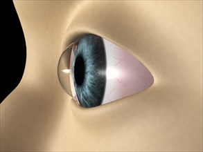 Medical illustration showing keratoconus in the eye. Keratoconus is a disorder that results in