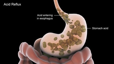 Biomedical illustration of acid reflux in the stomach