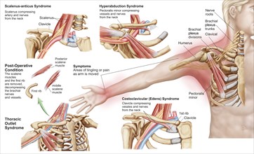 Medical illustration detailing thoracic outlet syndrome