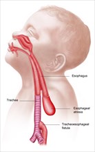 Anatomy of a tracheoesophageal fistula