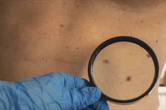 Unrecognizable Dermatologist examining patient's birthmark with magnifying glass in clinic. Mole