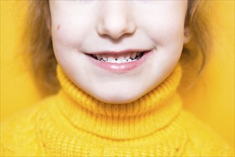 Girl shows her teeth-pathological bite, malocclusion, overbite. Pediatric dentistry and